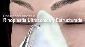 rinoplastia ultrasónica con el experto en cirugía de nariz Alejandro Afanador