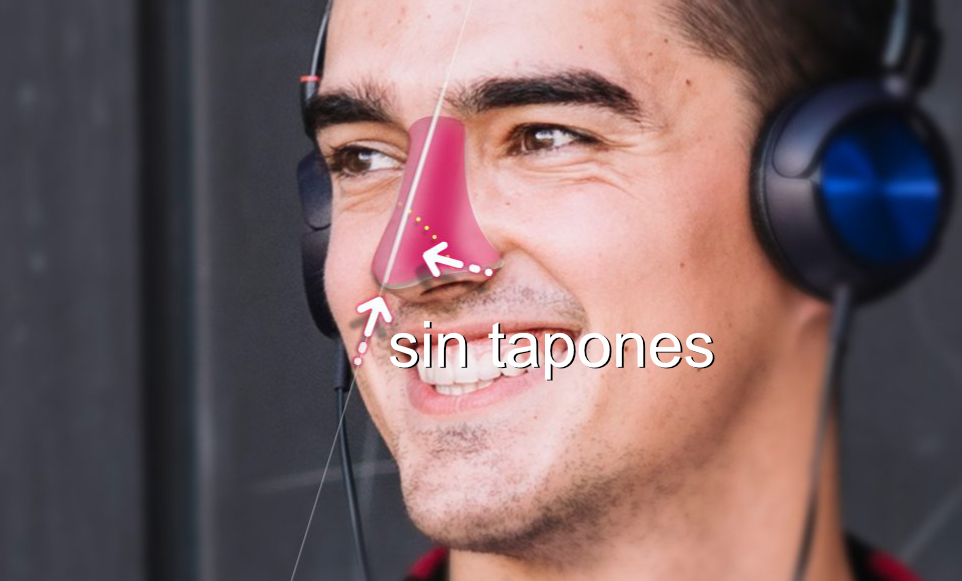 rinoplastia o cirugía de nariz sin tapones nasales